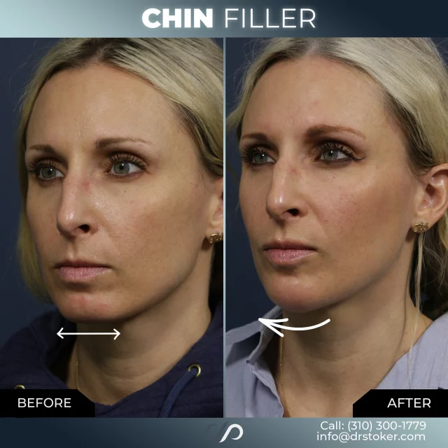 Chin Filler 💉✨ // #filler 

IMPROVES👇
✨Facial Symmetry 
✨Chin Projection 
✨Jawline Definition 

👋BOOK NOW | In-office or virtual appointments by sending your name, number, and email to the DM. 

📲 CALL US | questions regarding treatment: (310) 300-1779

📩Email: Info@drstoker.com

🛍 SHOP SKINCARE | Link in bio 🔗

COMMENT BELOW 🔽
.
.
.
.
#plasticsurgery #plasticsurgeon #cosmeticsurgery #beauty #liposuction #surgery #rhinoplasty #tummytuck #losangeles #bbl #botox #breastaugmentation #beforeandafter #yelp #nosejob #facelift #mommymakeover #skincare #aesthetics #surgeon #aesthetic #antiaging #filler #cosmeticsurgeon #breastlift #aestheticsurgery #doctor #dermatology