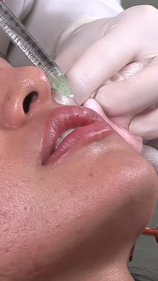 Lip Filler 👄✨// #lipfiller #enhancement

✨Instant Results
✨Non-Invasive
✨Customizable 

💕 Lip filler doesn’t have to be dramatic or unnatural. Results depend on the type of filler used and the amount injected. Some fillers are designed to add subtle hydration and smoothness, while others are used to build volume and shape. As lips age, they lose structure and moisture, just like other areas of the face. 

💕Restoring these qualities can enhance a youthful appearance without overcorrection. A personalized approach is key, so it’s important to discuss your goals and options with a qualified injector.

✅ Visit our website, drstoker.com, to view striking before and after photos and discover our full range of rejuvenation services. Start your journey to a more youthful look today!

👋 BOOK NOW | in-office or virtual appointments by sending your name, number, and email to the DM. 

📲 CALL US | questions regarding treatment: (310) 300-1779

📩Email: Info@drstoker.com

🛍 SHOP SKINCARE | Link in bio 🔗

COMMENT BELOW 🔽
.
.
.
.
#lipfillerbeforeandafter #dermalfiller #cosmeticinjector #juvederm #restylanel #juvedermultra  #fillers #filler #lipflip #plumplips #lipaugmentation #lipfillers #lipenhancement #antiaging #aesthetics #lipgoals #lipenvy #skin #injectables #plasticsurgery #cheekfiller #lips #aestheticsexpert #selfcare #beforeandafter #skincareroutine