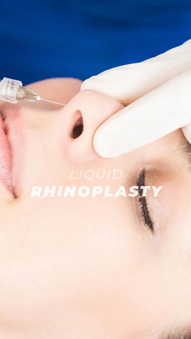 Liquid Rhinoplasty 💉👃💖// #injectables 

✅Liquid rhinoplasty involves the precise placement of dermal fillers to contour and reshape your nose, creating a more symmetrical and proportionate appearance that complements your facial features. This non-surgical procedure offers immediate results, allowing you to “test drive” the changes before considering surgery.

✨If you’re interested in discovering more about liquid rhinoplasty and if it’s the right choice for you, contact us today to book a consultation.

Want More? ✨
Our microneedling treatments are a popular way to rejuvenate the most exposed skin, such as the face, neck, décolletage, and even the hands!  Using our SkinPen device, the treatment allows your skin to repair and regenerate itself and increase collagen production. Visit us now at drstoker.com to learn more about the benefits of our microneedling treatment!

BOOK NOW | In-office or virtual appointments by sending your name, number, and email to the DM. 

📲 CALL US | questions regarding treatment: (310) 300-1779

📩Email: Info@drstoker.com

🛍 SHOP SKINCARE | Link in bio 🔗

COMMENT BELOW 🔽
.
.
.
.
#dermalfiller #nosejob #restylane #restylanel #filler #undereye #undereyefiller #fillers #teartroughfillers #teartroughs #teartrough #antiaging #aesthetics #undereyefiller #juvederm #skin #undereyebags #injectables #plasticsurgery #treatyoself #cheekfiller #botox #lips #undereyecircles #aestheticsexpert #selfcare #beforeandafter  #skincareroutinere