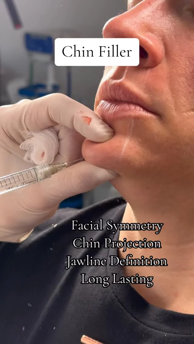 Chin Filler 💉✨ // #filler 

✨ Chin filler is a non-surgical treatment that uses dermal fillers to enhance chin shape, projection, and facial balance. Ideal for softening a recessed chin or creating a more defined jawline, this quick, low-downtime procedure delivers immediate, natural-looking results.

✔️ Improve facial harmony
✔️ Strengthen a weak chin
✔️ Sharpen the jawline
✔️ Non-surgical & minimal downtime

✨ Results typically last 12–18 months. Always choose a qualified injector to ensure safe, tailored results.

👋BOOK NOW | In-office or virtual appointments by sending your name, number, and email to the DM. 

📲 CALL US | questions regarding treatment: (310) 300-1779

📩Email: Info@drstoker.com

🛍 SHOP SKINCARE | Link in bio 🔗

COMMENT BELOW 🔽
.
.
.
.
#plasticsurgery #plasticsurgeon #cosmeticsurgery #beauty #liposuction #surgery #rhinoplasty #tummytuck #losangeles #bbl #botox #breastaugmentation #beforeandafter #yelp #nosejob #facelift #mommymakeover #skincare #aesthetics #surgeon #aesthetic #antiaging #filler #cosmeticsurgeon #breastlift #aestheticsurgery #doctor #dermatology