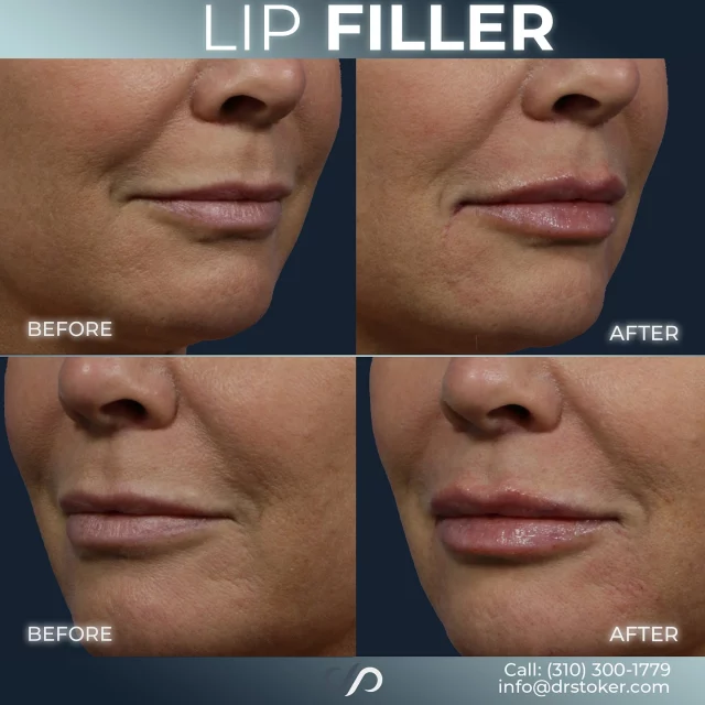 Lip Filler ✨💋✨// #lipfiller #enhancement

👄 Filler can hydrate, smooth, or restore lost definition—not just add volume. As lips age, they lose structure and moisture, which filler can gently enhance.

📌 With the right product and technique, results look natural and feel personalized. A skilled injector will tailor the approach to your goals.

✅ Visit our website, drstoker.com, to view striking before and after photos and discover our full range of rejuvenation services. Start your journey to a more youthful look today!

👋 BOOK NOW | in-office or virtual appointments by sending your name, number, and email to the DM. 

📲 CALL US | questions regarding treatment: (310) 300-1779

📩Email: Info@drstoker.com

🛍 SHOP SKINCARE | Link in bio 🔗

COMMENT BELOW 🔽
.
.
.
.
#lipfillerbeforeandafter #dermalfiller #cosmeticinjector #juvederm #restylanel #juvedermultra  #fillers #filler #lipflip #plumplips #lipaugmentation #lipfillers #lipenhancement #antiaging #aesthetics #lipgoals #lipenvy #skin #injectables #plasticsurgery #cheekfiller #lips #aestheticsexpert #selfcare #beforeandafter #skincareroutine
