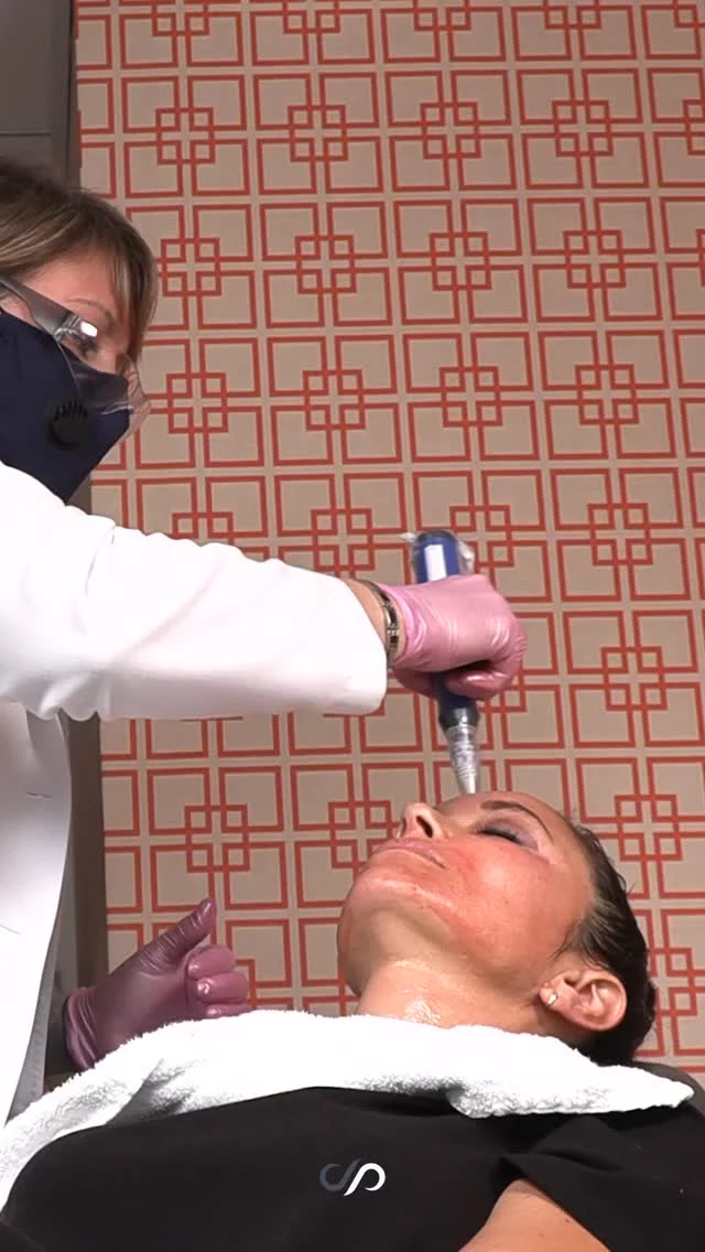 Microneedling Treatment 😍// #Skinpen #rejuvenation 

BENEFITS? 💫
🪄Reduces Fine Lines & Wrinkles
🪄Evens Skin Tone
🪄Improves Texture
🪄Safe For All Skin Types
🪄Minimal Downtime

🌟Microneedling is a fantastic for so many skin concerns! It helps with fine lines, wrinkles, skin texture, enlarged pores, acne, and even acne scarring.

🌟What’s great about microneedling is that it’s safe for all skin types and helps stimulate collagen production, which is key for maintaining healthy, youthful skin. Over time, it improves the overall appearance and texture of your skin.

✨ Visit drstoker.com to learn more about how SkinPen microneedling can elevate your skincare journey!

👋 BOOK NOW | In-office or virtual appointments by sending your name, number, and email to the DM.

📲 CALL US | questions regarding treatment: (310) 300-1779

🛍 SHOP SKINCARE | Link in bio 🔗

COMMENT BELOW ⬇️
.
.
.
.
#microneedling #skincare #acnescars #facialrejuvenation #aesthetics #beauty #dermapen #glowingskin #skintreatment #skincareroutine #collagenproduction #esthetics #microneedlingfacial #beautytreatment #microneedlingtherapy #microneedlingbeforeandafter #microneedlingresults #beautyhacks