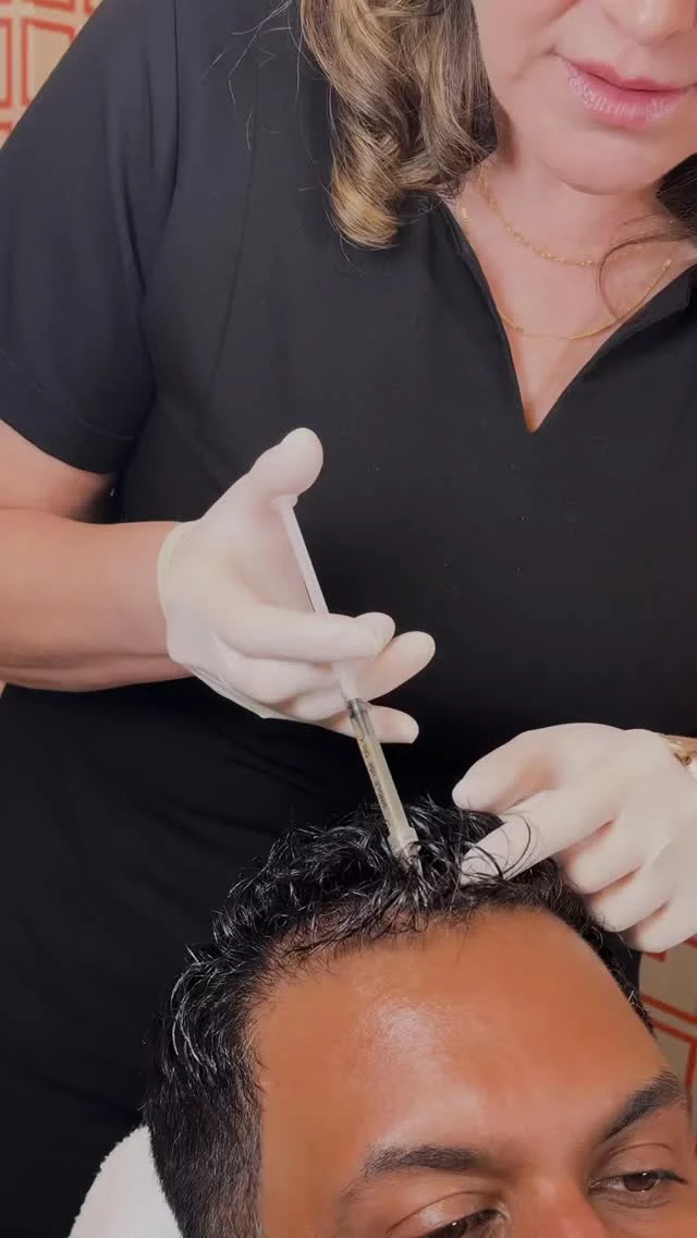 Exosomes Therapy for Hair Growth ✨// #exosome #exosometherapy

✨Exosome therapy harnesses the power of stem cells to rejuvenate hair follicles. By injecting exosomes into thinning areas of the scalp, this treatment enhances hair density and strength, promoting healthier, more robust hair growth. Patients typically notice visible improvements within three months post-treatment.

👋BOOK NOW | In-office or virtual appointments by sending your name, number, and email to the DM. 

📲 CALL US | questions regarding treatment: (310) 300-1779

📩Email: Info@drstoker.com

🛍 SHOP SKINCARE | Link in bio 🔗

COMMENT BELOW 🔽
.
.
.
.
#juvederm #botox #fillers #lipfiller #lips #restylane #beauty #filler #aesthetics #skincare #dermalfillers #lipfillers #lipinjections #antiaging #injectables #dysport #allergan #medspa #juvedermlips #microneedling #voluma #lipenhancement #plasticsurgery #beforeandafter #aesthetic #cheekfiller #prp