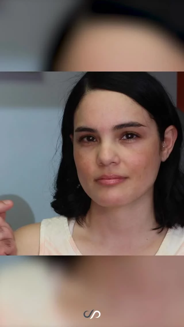 Surgical Results, Perfected with Filler ✨ 👁// #eyelidlift 

✨ Three months after lower eyelid surgery using a transconjunctival approach to smooth puffiness and remove excess fat, this patient received a touch of hyaluronic acid filler to the tear troughs. 

✨ The filler softened any remaining hollowness and blended the eyelid and cheek for a smooth, refreshed look. 

✨ This result shows how combining surgical and non-surgical treatments can create a naturally balanced and rejuvenated appearance.

🙌 BOOK NOW | in-office or virtual appointments by sending your name, number, and email to the DM. 

📲 CALL US | questions regarding treatment: (310) 300-1779

📩Email: Info@drstoker.com

🛍 SHOP SKINCARE | Link in bio 🔗

COMMENT BELOW 🔽
.
.
.
.
#blepharoplasty #plasticsurgery #facelift #eyelidsurgery #eyelift#blepharoplastysurgeon  #eyelidrejuventation #upperblepharoplasty #upperbleph #uppereyelids #antiaging #eyes  #facialrejuvenation #facialplasticsurgery #lowerbleph #cosmeticsurgery #plasticsurgeon #surgery #beauty #skintightening #beforeandafter #aesthetic #maleplasticsurgery #drstoker #boardcertified #boardcertifiedplasticsurgeon #hollywood #beverlyhills