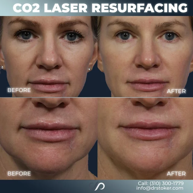 CO2 Laser Resurfacing✨ // #facialrejuvenation 

Benefits ✨
👉Boosts Collagen Production
👉Swift Downtime
👉Enhances Skin Texture
👉Evens Out Skin Tone

✅Utilizing light energy, CO2 laser resurfacing delicately eliminates thin skin layers, stimulating collagen synthesis. The regenerated skin reveals a fresh, healthy layer, effectively addressing concerns like acne scars and sun damage. 

✅ While commonly applied to the face for rapid healing, CO2 laser extends to the neck, chest, and hands. 

❤️‍🩹The healing process, spanning 3 to 14 days, involves initial redness lasting 3 to 10 days. By Day 3 or 4, peeling occurs, unveiling revitalized skin and enhancing overall skin tone and texture.

👋BOOK NOW | In-office or virtual appointments by sending your name, number, and email to the DM. 

📲 CALL US | questions regarding treatment: (310) 300-1779

📩Email: Info@drstoker.com

🛍 SHOP SKINCARE | Link in bio 🔗

COMMENT BELOW 🔽
.
.
.
.
#co2 #laser #skinresurfacing #wrinkleremoval #facelift #necklift #skincare #laserskinresurfacing #skin #dermatology #fractionalco #blepharoplasty  #skinrejuvenation #skintightening  #cosmeticsurgery #wrinkles #surgery #rejuvenation #skin #depptrial #plasticsurgeon #transformation #plasticsurgery