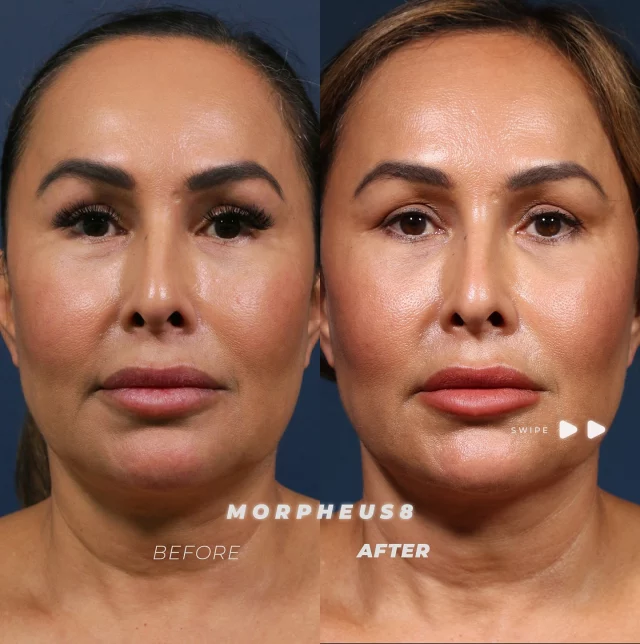 Morpheus8 Treatment ✨ // #morpheus8

Why Choose Morpheus8?
✨ Stimulates Natural Collagen Production
✨ Smooths Fine Lines & Wrinkles
✨ Gentle, Non-Surgical Approach

👉 Morpheus8 uses microneedling and radiofrequency to boost collagen and rejuvenate skin from within, leaving it firmer, smoother, and more youthful.

👉 Performed in a series of three sessions spaced about four weeks apart, it’s ideal for early prevention or treating visible signs of aging with minimal downtime.

👋BOOK NOW | In-office or virtual appointments by sending your name, number, and email to the DM.

📲 CALL US | questions regarding treatment: (310) 300-1779

🛍 SHOP SKINCARE | Link in bio 🔗 

COMMENT BELOW 🔽
.
.
.
.
#dermalfiller #botox #beauty #antiaging #aesthetics #fillers #undereyefiller #dermalfiller #medicalspa #juvederm #skin #lipfiller #injectables #plasticsurgery #facial #cheekfiller #lips #esthetician #aestheticsexpert #facials #dermalfillers #selfcare #microneedling #dysport #bodycontouring #restylane #laser #skincareroutine