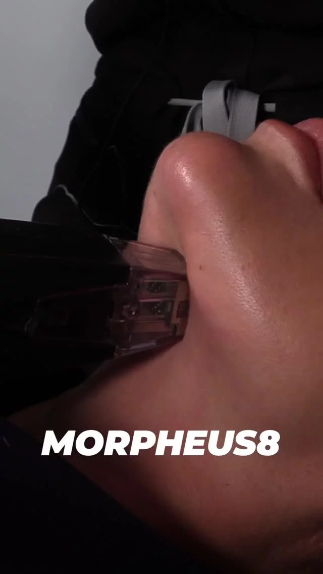Morpheus8 for Skin Tightening ✨ // #morpheus8

✅ Morpheus8 is an advanced treatment that combines microneedling with radiofrequency to target both skin tightening and fat reduction. Although it’s commonly used for facial treatments, it’s also highly effective on areas like the abdomen.

✅ This innovative therapy works to tighten the skin, reduce wrinkles, and improve the appearance of stretch marks, offering a comprehensive solution for firmer, smoother skin.

👋BOOK NOW | In-office or virtual appointments by sending your name, number, and email to the DM.

📲 CALL US | questions regarding treatment: (310) 300-1779

🛍 SHOP SKINCARE | Link in bio 🔗 

COMMENT BELOW 🔽
.
.
.
.
#dermalfiller #botox #beauty #antiaging #aesthetics #fillers #undereyefiller #dermalfiller #medicalspa #juvederm #skin #lipfiller #injectables #plasticsurgery #facial #cheekfiller #lips #esthetician #aestheticsexpert #facials #dermalfillers #selfcare #microneedling #dysport #bodycontouring #restylane #laser #skincareroutine