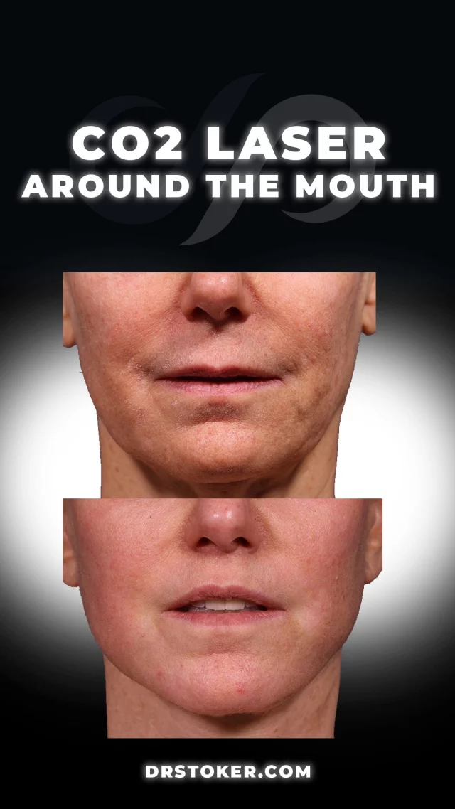 CO2 Laser (Mouth Region) ✨👄✨// #rejuvenation

✨ This 59-year-old patient underwent fractional CO₂ laser resurfacing targeting the lips, chin, and neck. At just over two months post-treatment, there’s already significant improvement in skin texture and tightness, particularly in the lower face and submental region. 

✨ Results will continue to improve as healing progresses, highlighting the effectiveness of this procedure for facial rejuvenation.

⭐️BOOK NOW | In-office or virtual appointments by sending your name, number, and email to the DM.

📲 CALL US | questions regarding treatment: (310) 300-1779

🛍 SHOP SKINCARE | Link in bio 🔗

COMMENT BELOW ⬇️ 
.
.
.
.
#skincare #co2laser